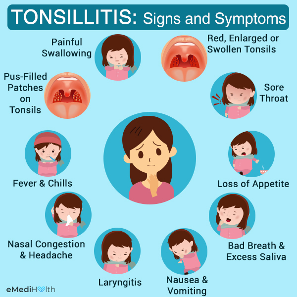 tonsillitis-early-stages