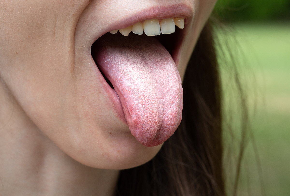 What Does A White Tongue And Sore Throat Mean