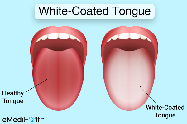 symptoms of a white tongue