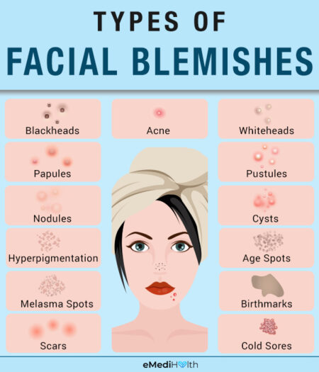 Facial Blemishes: Causes, Types, and Treatment - eMediHealth