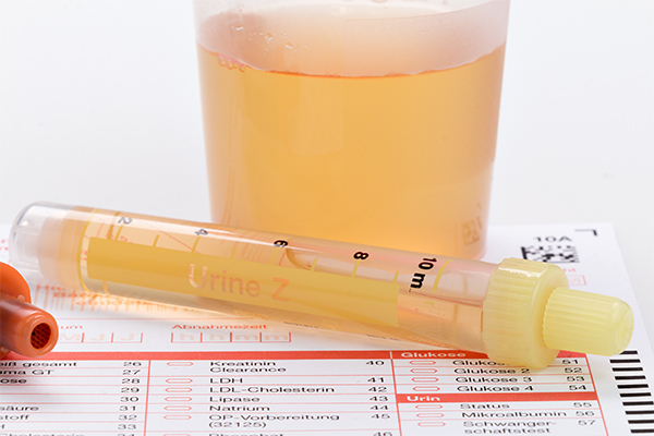 blood in the urine (hematuria) is indicative of a kidney disease