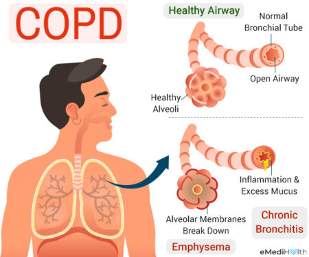 what causes copd