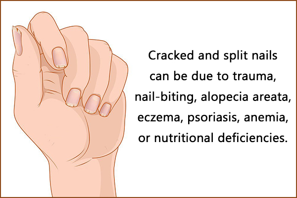 causes of cracked and split nails