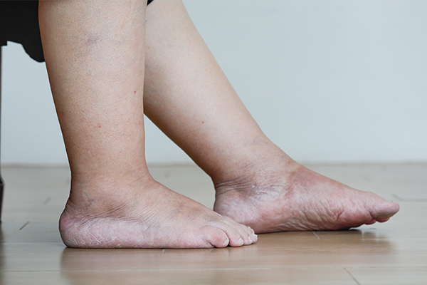 edema in the legs is a common sign of an kidney disease