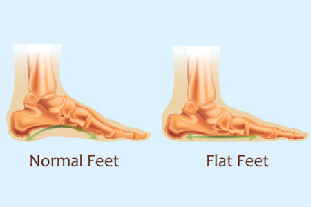 foot surgery for flat feet