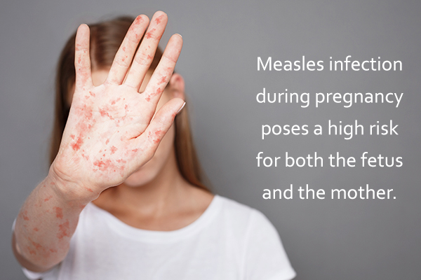 complications of measles