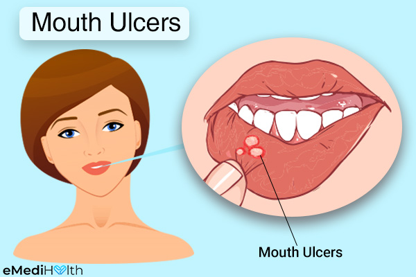 what causes mouth ulcers?