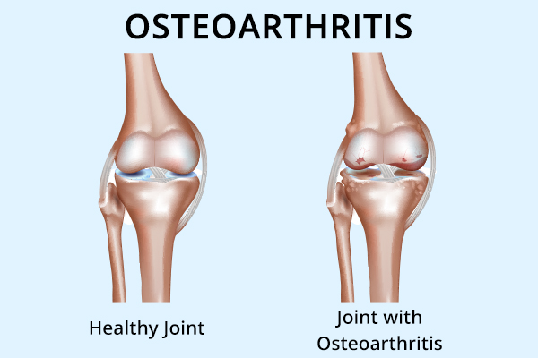diagnosis of osteoarthritis