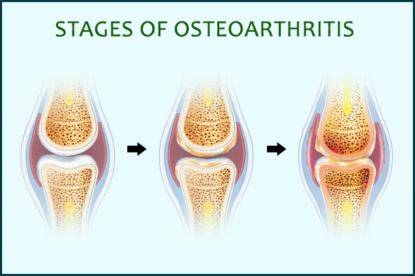 Types Of Osteoarthritis And How Does It Progress Emedihealth 2480