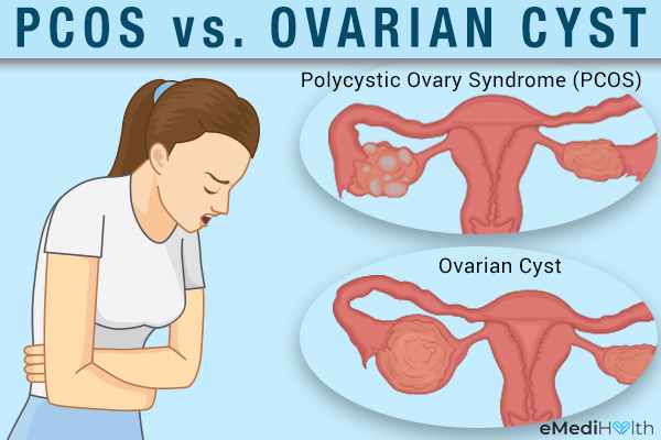 PCOS versus ovarian cyst