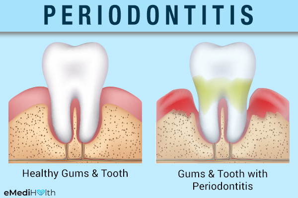 prevalence of periodontitis