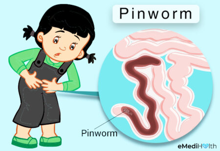 pin worm poop