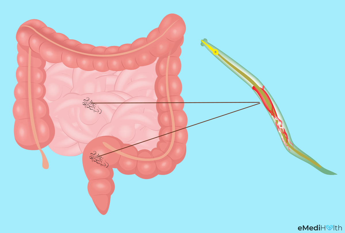 pinworm diagram helmint kezelés után