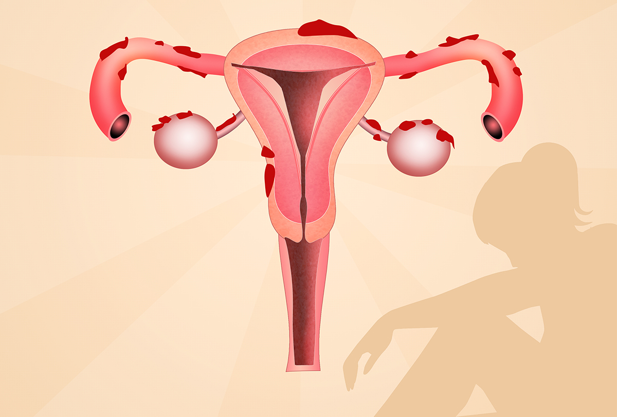signs and symptoms which indicate endometriosis
