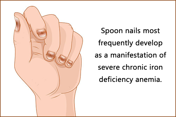 what causes spoon nails?