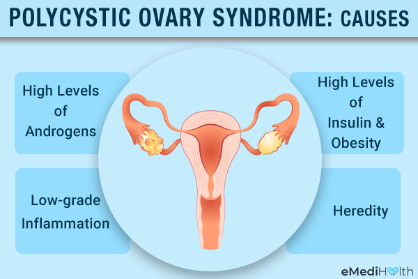 causes of polycystic ovary syndrome (PCOS)