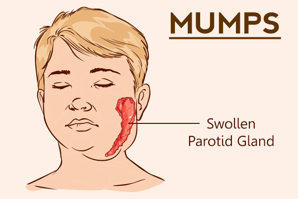 stages of mumps progression