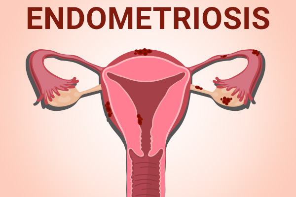 prevalence of endometriosis