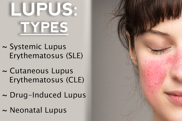 Types of Lupus Disease, Symptoms, & Flare-Ups - eMediHealth