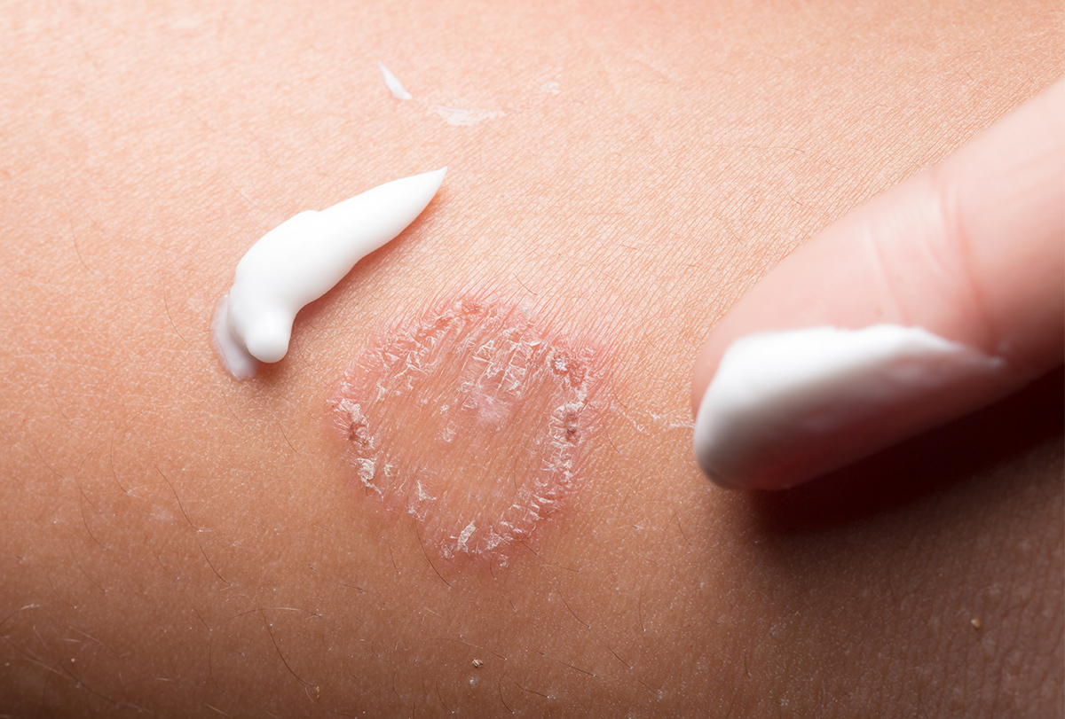 Does Hand Sanitizer Kill Ringworm On Skin?  