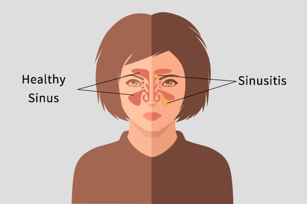 what is sinusitis?