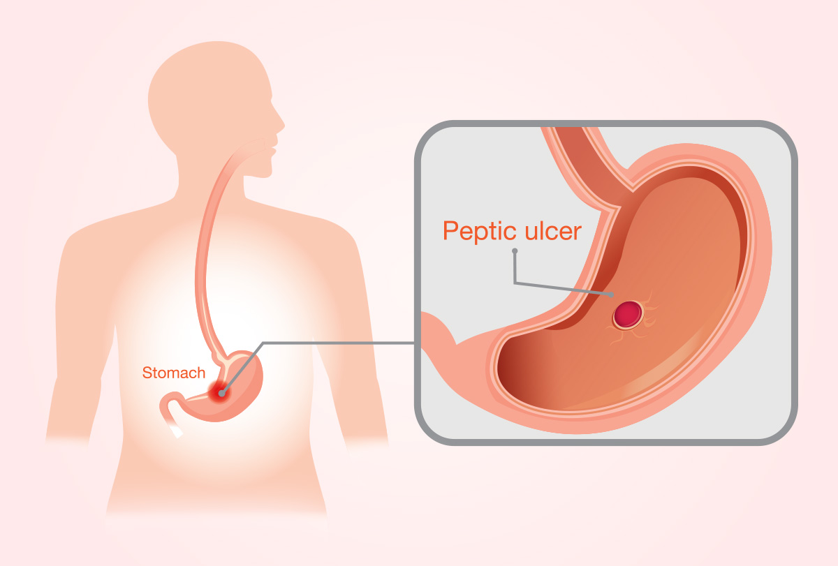 stomach ulcer pain location