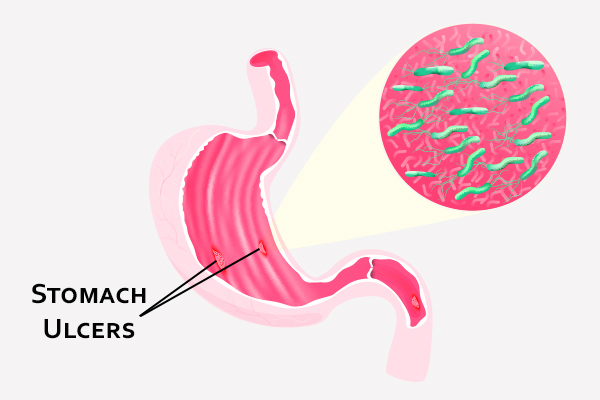 what are stomach ulcers?