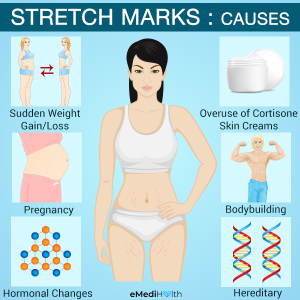 Stretch Marks Causes And Treatment Options Emedihealth