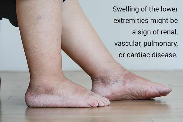 swelling in the legs can be a sign of cardiac disease