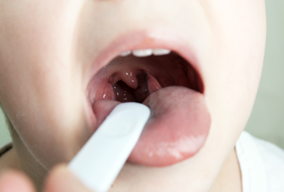 An Ent Tells You How To Get Rid Of Tonsil Stones