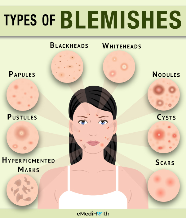 Different types of blemishes