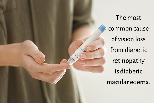 diabetes is the major contributor to macular edema