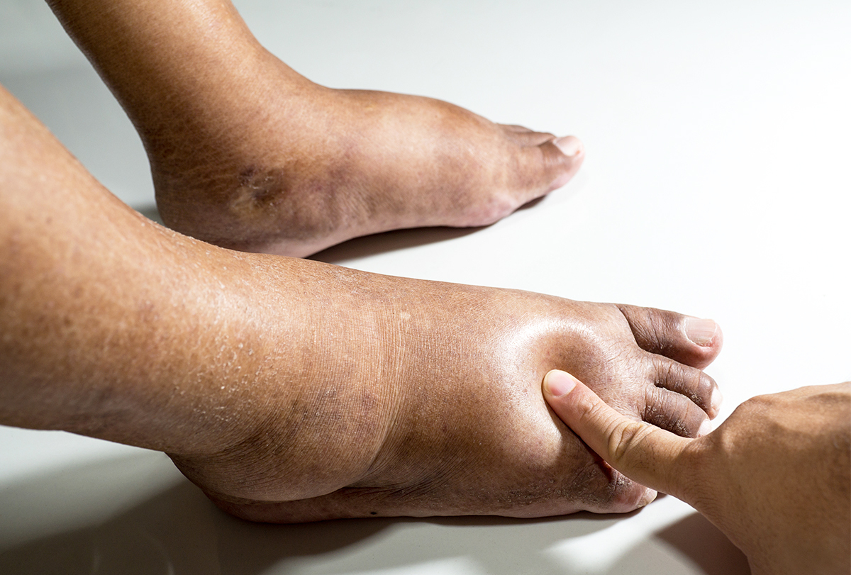 Edema: Stages, Types, Causes, Treatment, Risks - eMediHealth