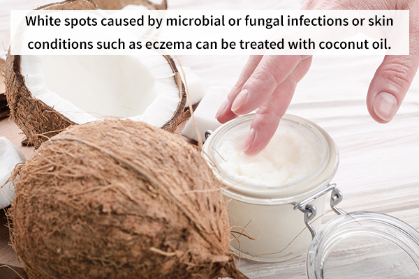 white spots or lesions can be treated with coconut oil