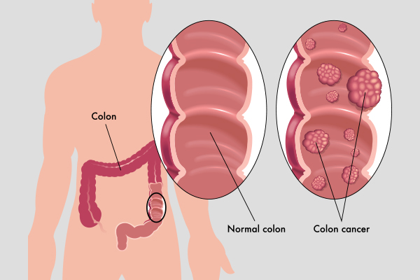 prevalence of colon cancer