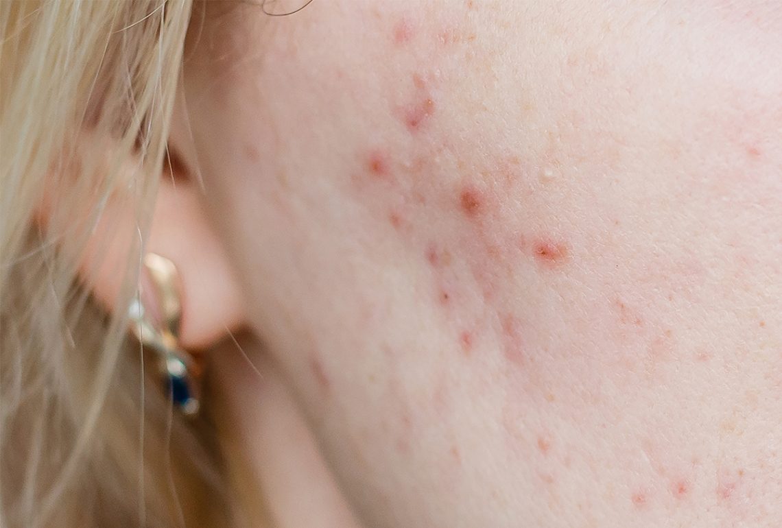 Cystic Acne Causes Symptoms Medical Treatment