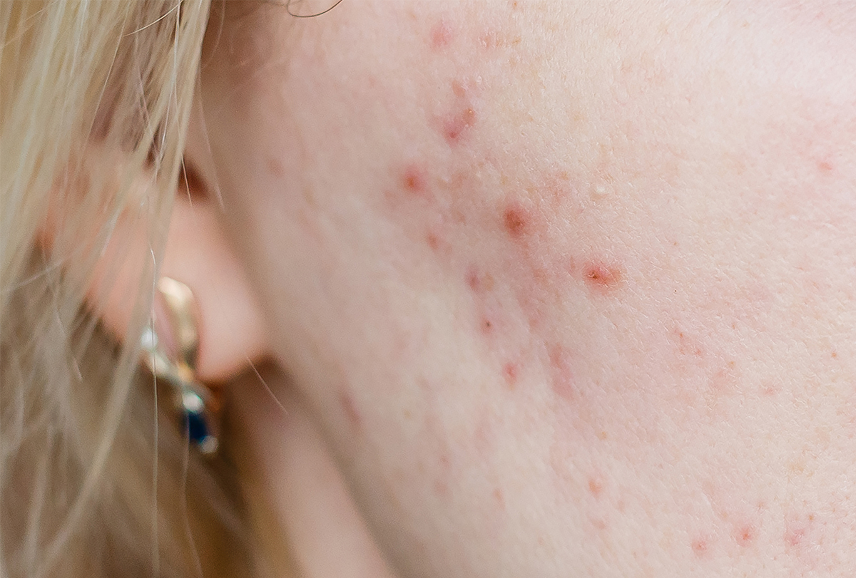 cystic acne