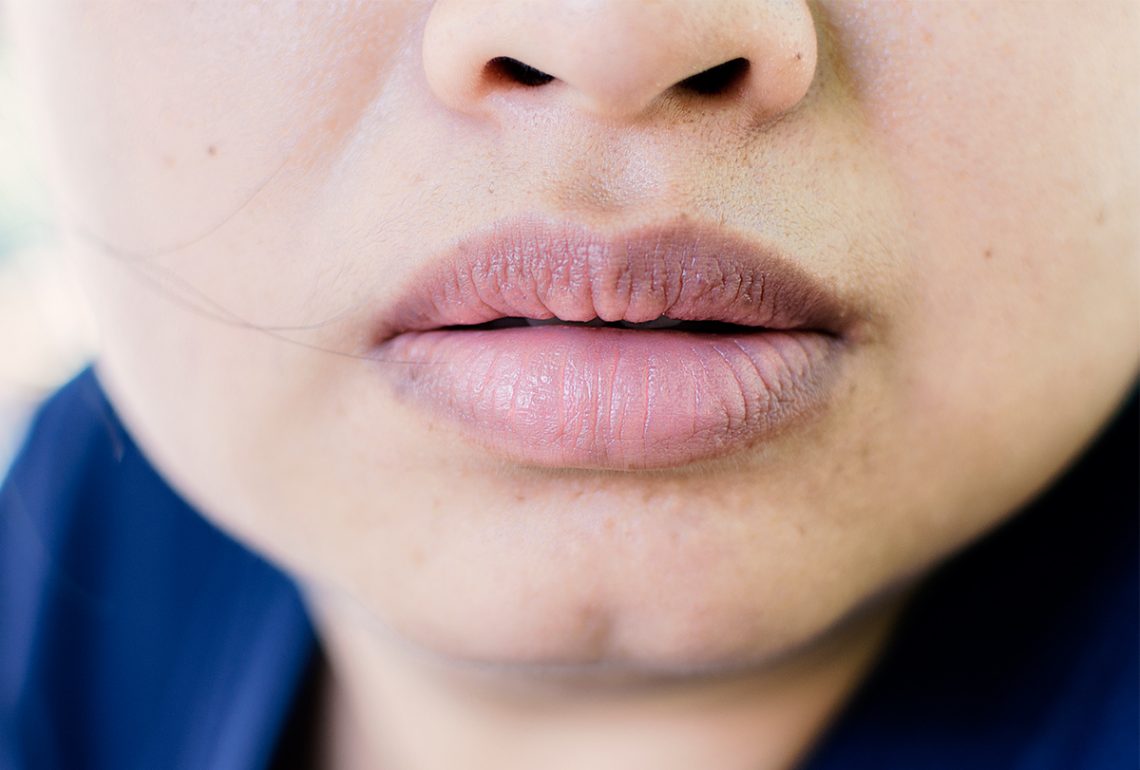 Symptoms Dark Spots On Lips
