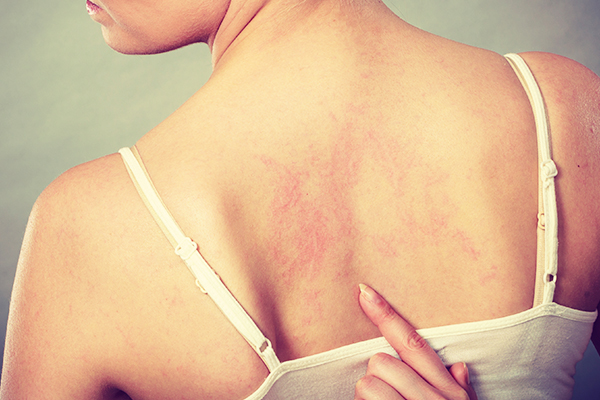 can eczema scars fade away on their own?