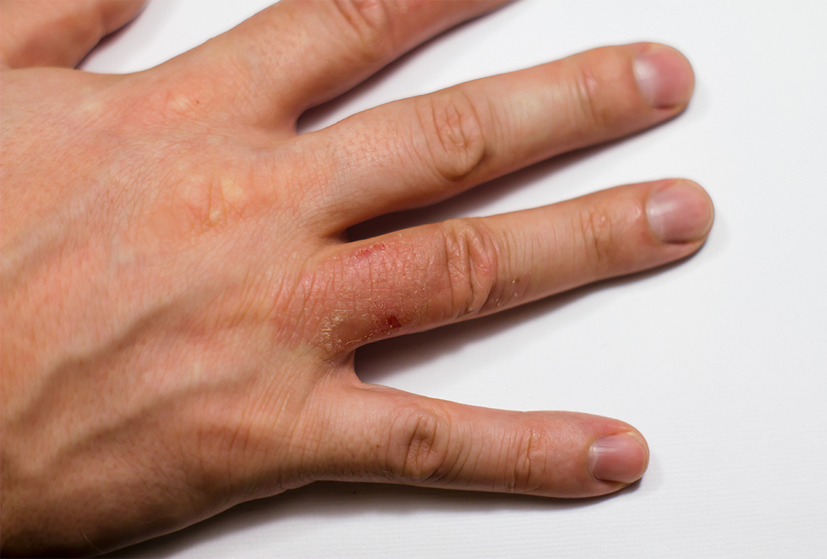 Eczema Types Causes Symptoms Medical Treatment