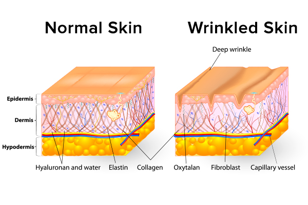 what causes forehead wrinkles?