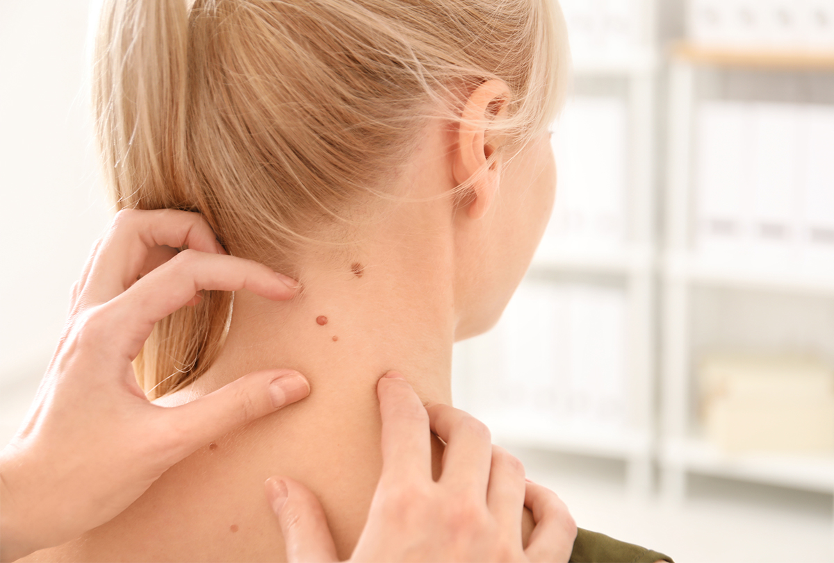 home remedies for skin tags