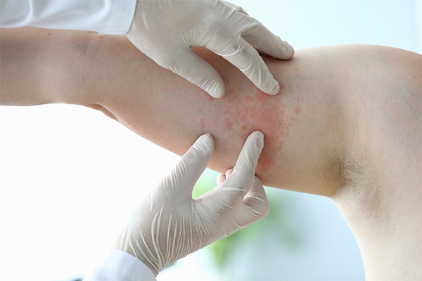 when to consult a doctor regarding chafed skin?