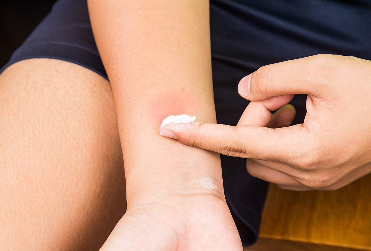 at-home remedies for yellow jacket stings