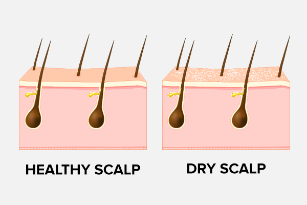 Dry Scalp Causes Symptoms And Treatment Emedihealth 