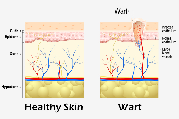 characteristics of warts
