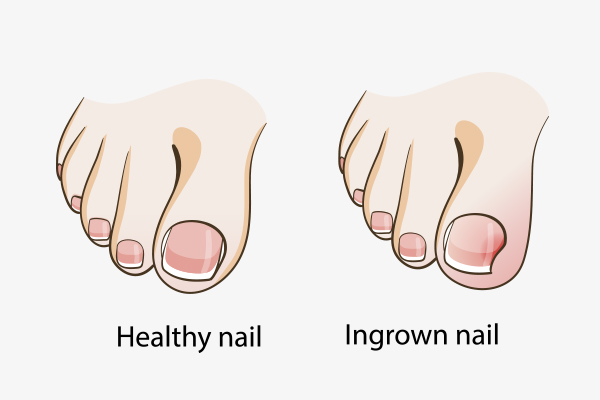 causes behind ingrown toenail