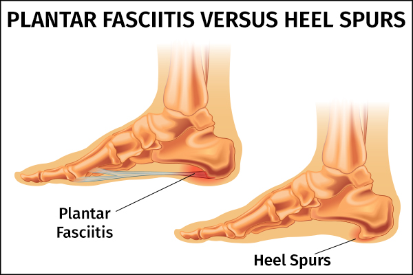 plantar fasciitis versus heel spurs