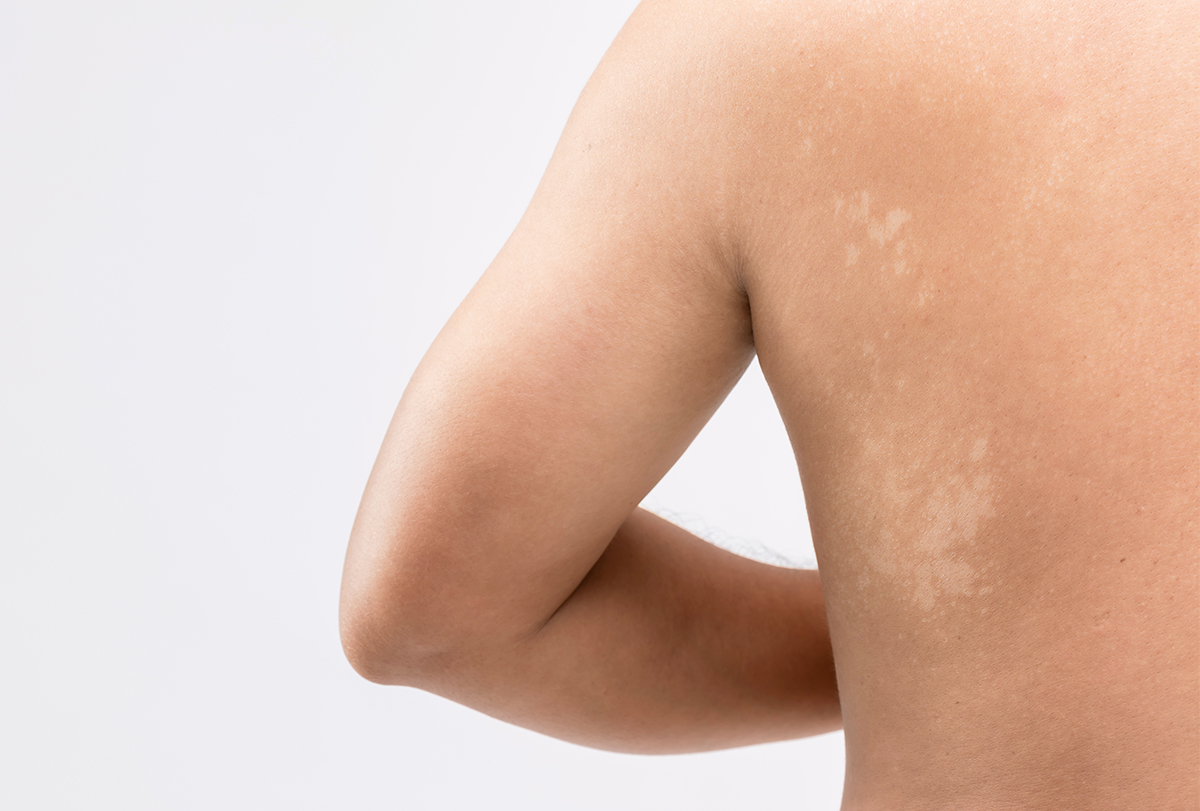 can tinea versicolor get on mattress