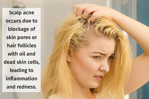 causes behind scalp acne